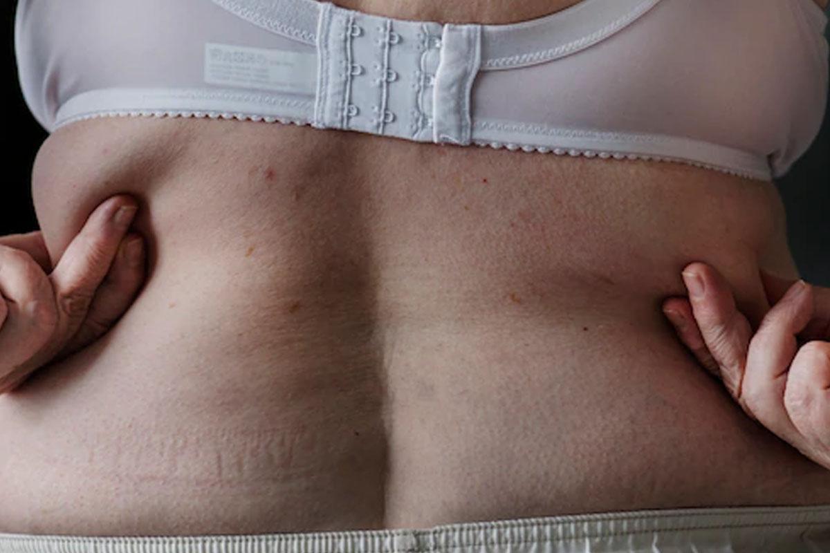 tratamento para obesidade